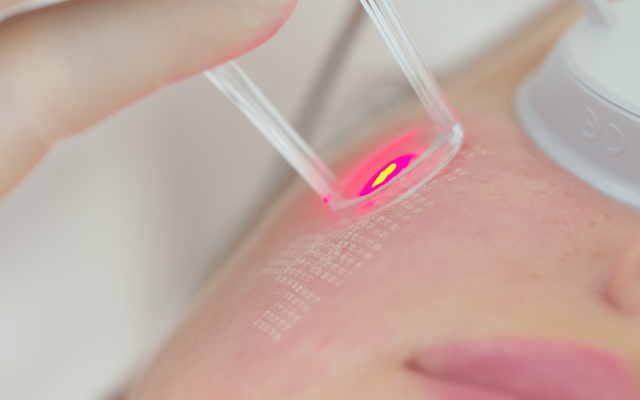 Лазерная шлифовка постакне Лазерная шлифовка постакне