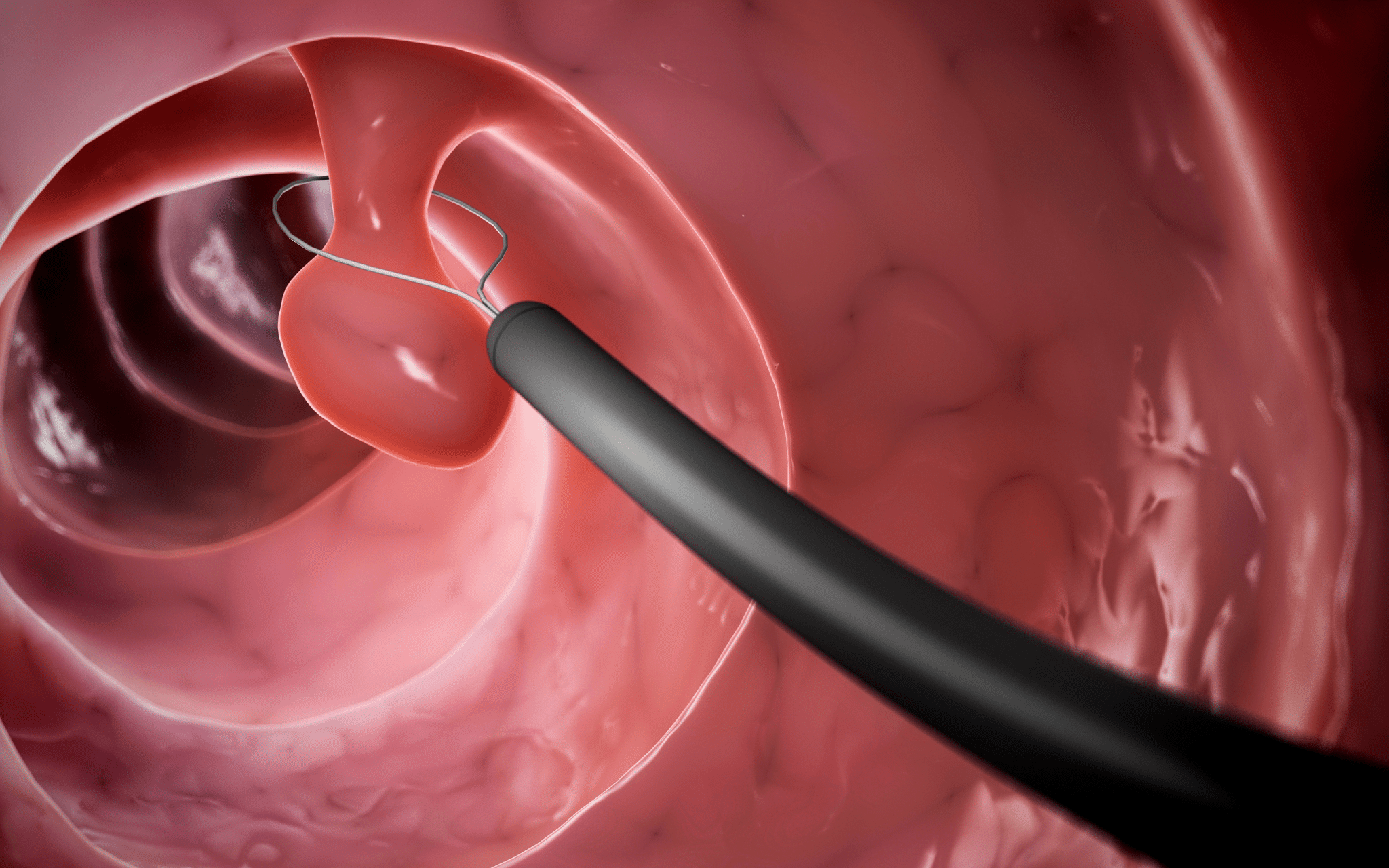 Хирургическое иссечение полипов в Киеве Хирургическое иссечение полипов в Киеве