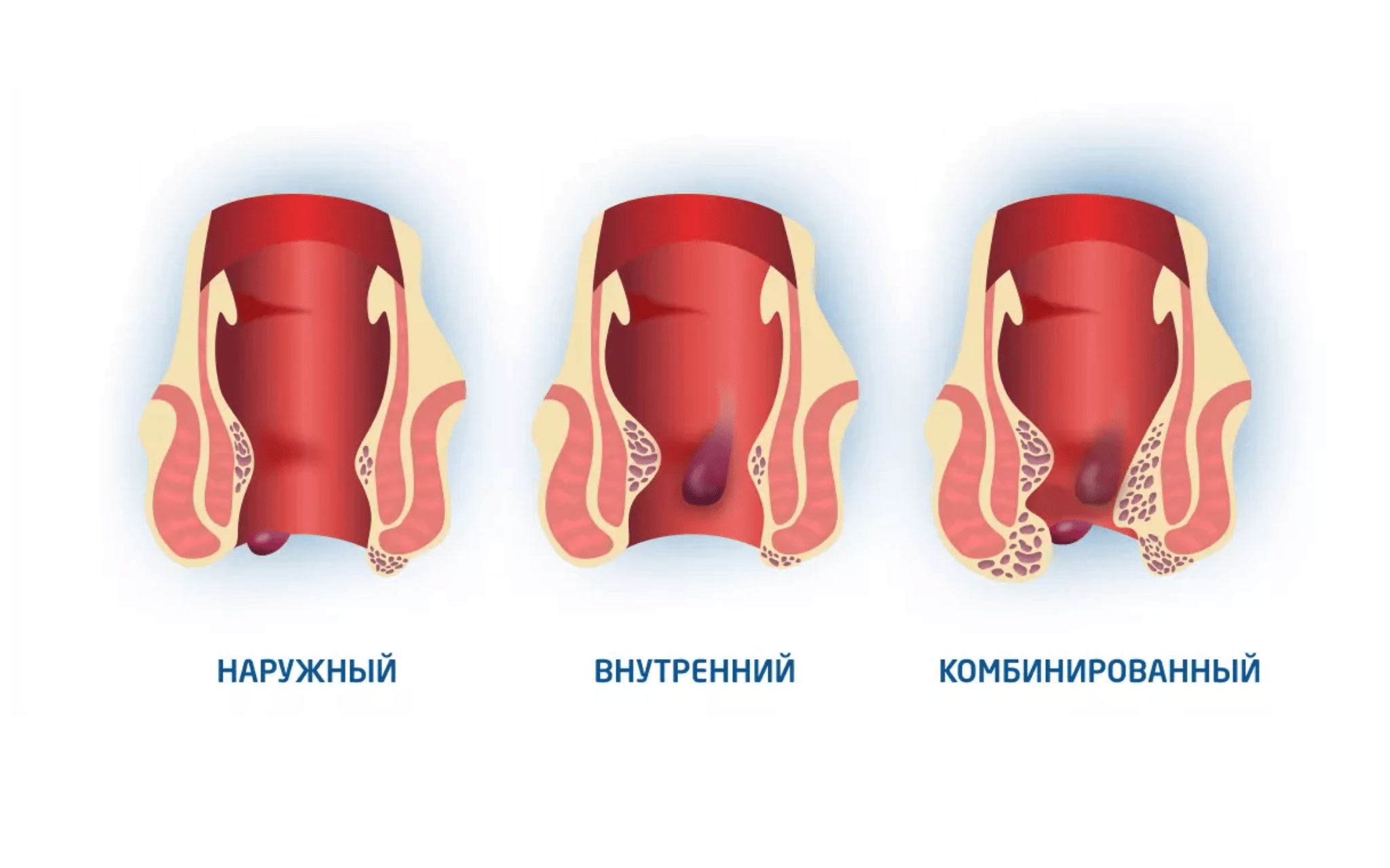 Лечение геморроя в Киеве Лечение геморроя в Киеве