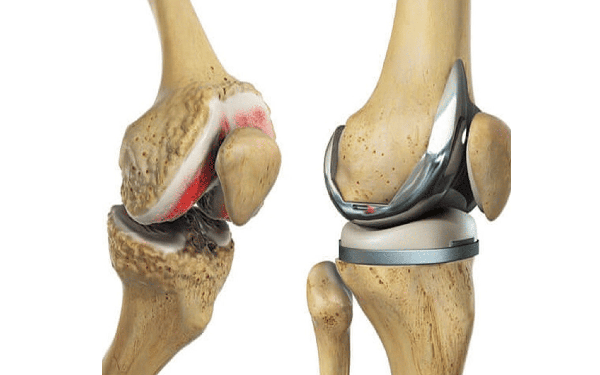 Эндопротезирование суставов в Киеве Эндопротезирование суставов в Киеве