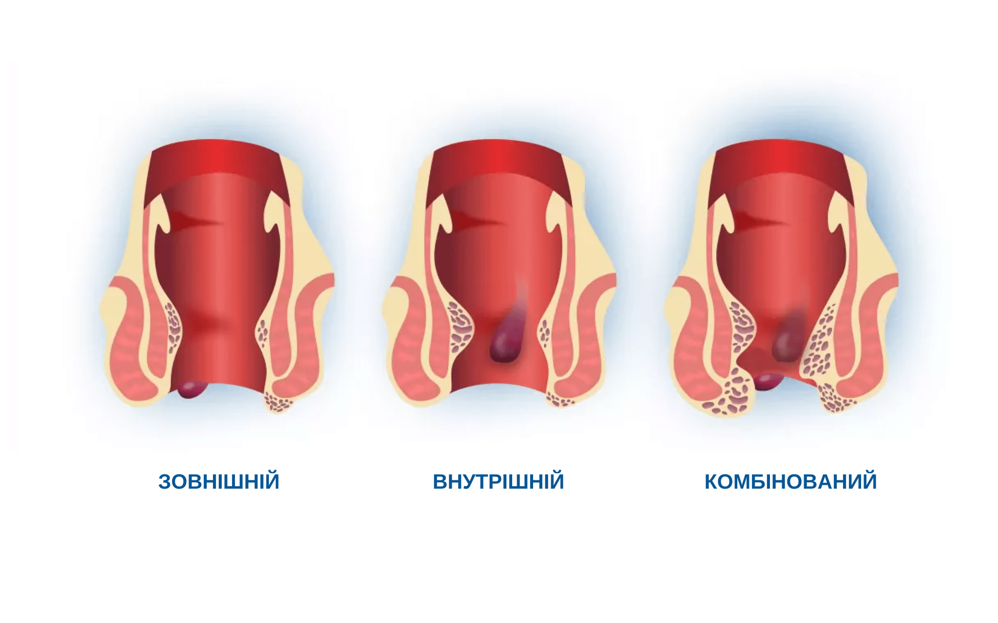Лікування геморою в Києві Лікування геморою в Києві