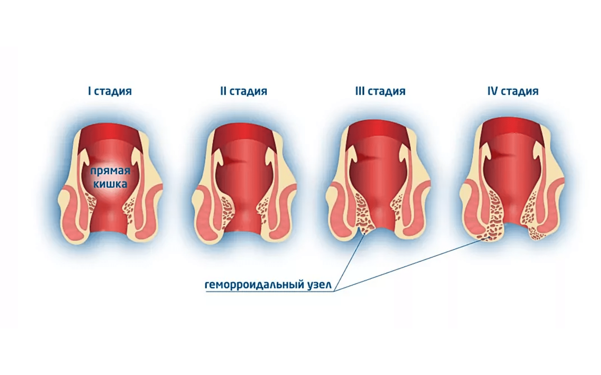 Лечение геморроя в Киеве Лечение геморроя в Киеве