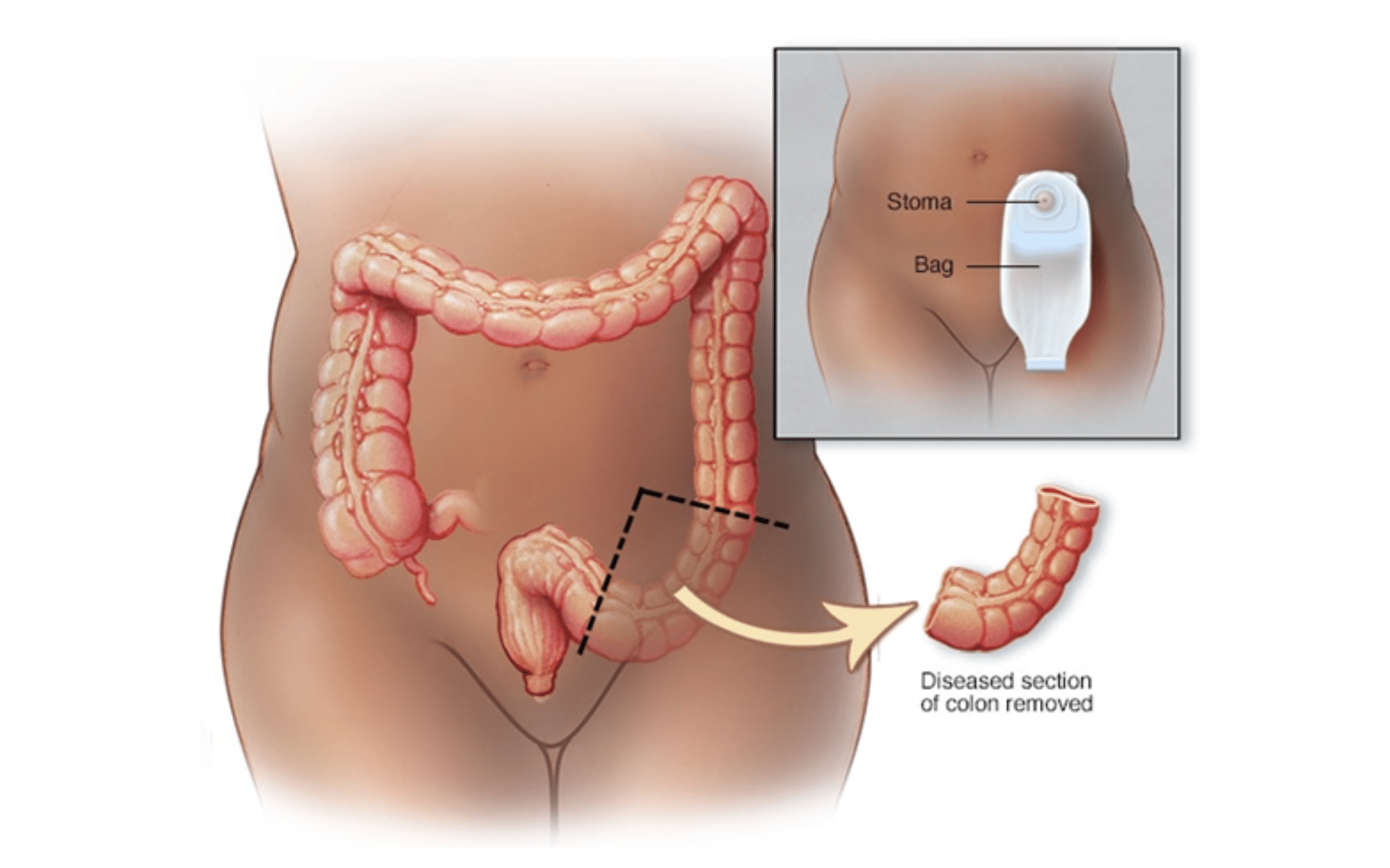 Операция Гартмана (резекция сигмовидной кишки) в Киеве Операция Гартмана (резекция сигмовидной кишки) в Киеве