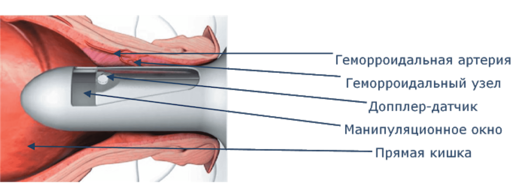 HAL-RAR дезартеризация геморроидальных узлов в Киеве HAL-RAR дезартеризация геморроидальных узлов в Киеве