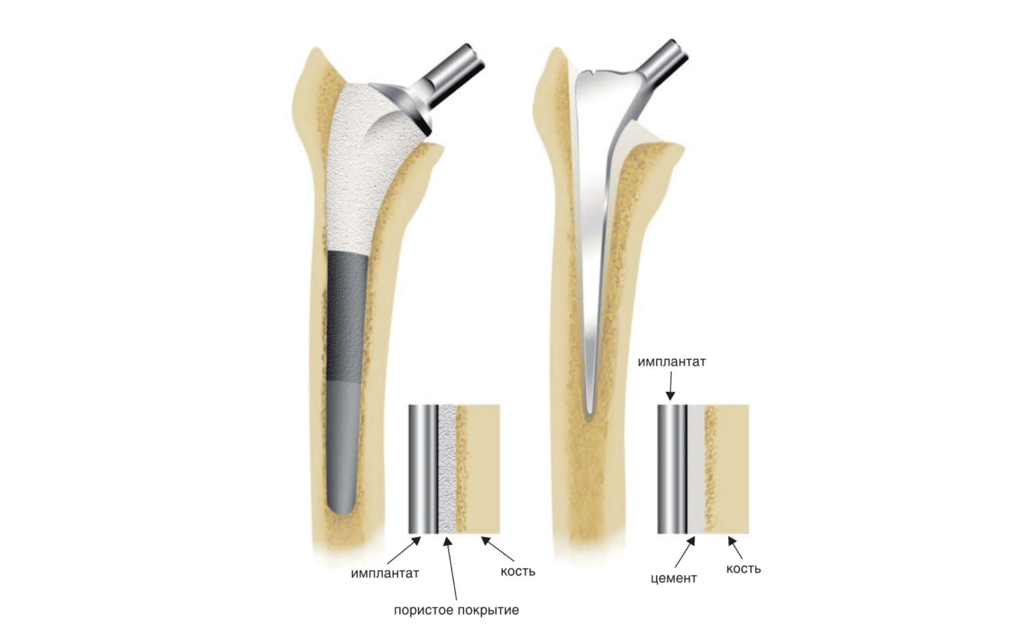 Эндопротезирование тазобедренного сустава в Киеве Эндопротезирование тазобедренного сустава в Киеве