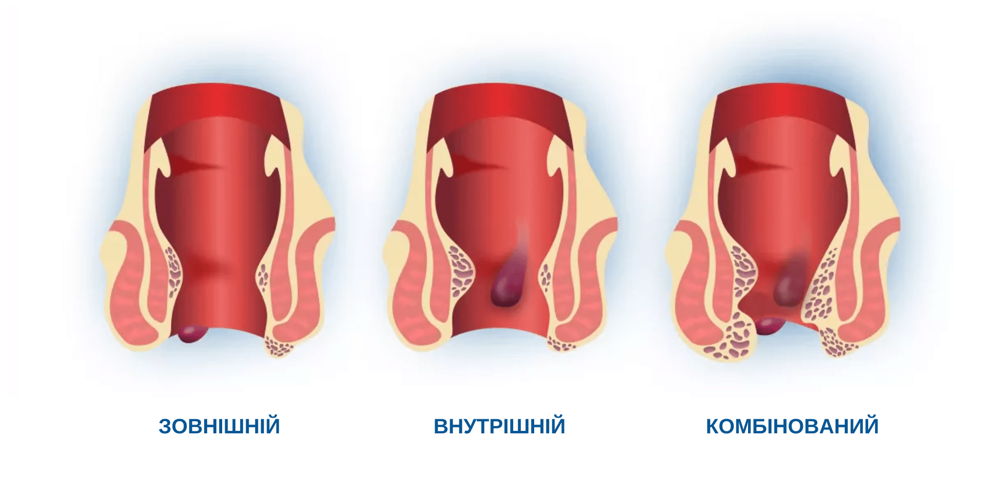 Лікування внутрішнього геморою у Києві Лікування внутрішнього геморою у Києві
