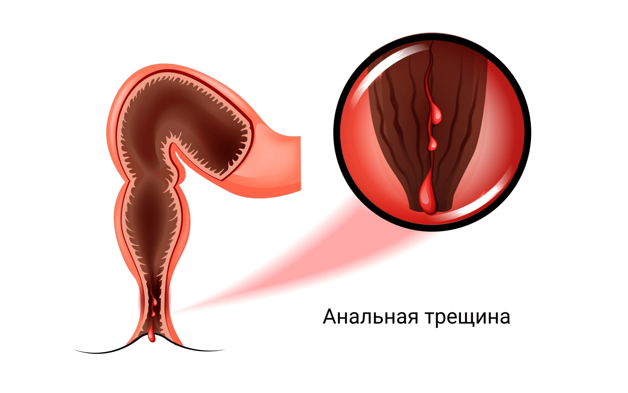 Иссечение анальной трещины с дозированной сфинктеротомией и анопластикой Иссечение анальной трещины с дозированной сфинктеротомией и анопластикой