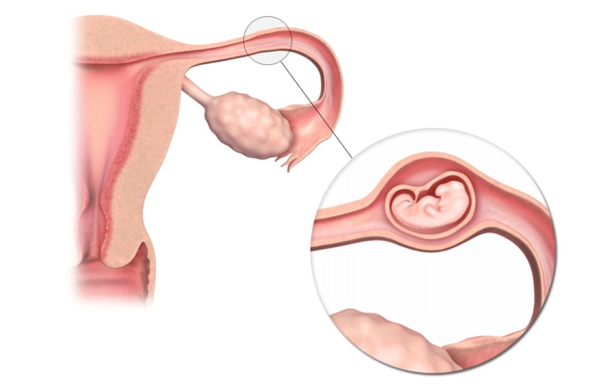 Операция при внематочной беременности Операция при внематочной беременности