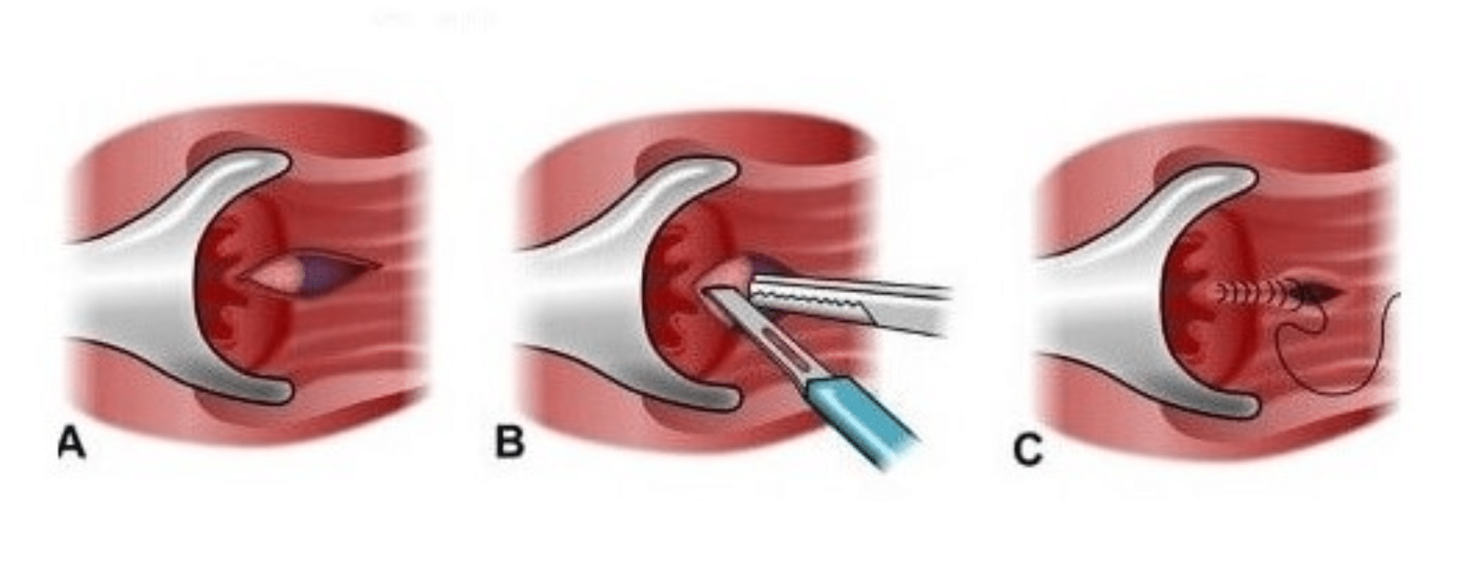 Иссечение анальной трещины с дозированной сфинктеротомией и анопластикой Иссечение анальной трещины с дозированной сфинктеротомией и анопластикой