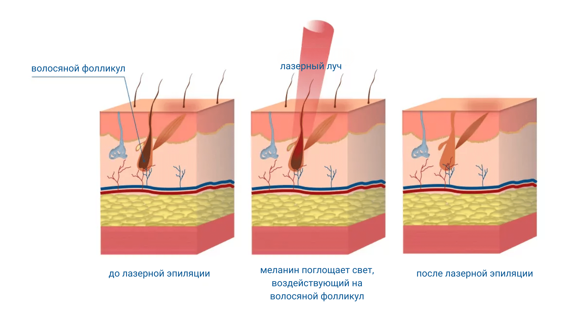 Лазерная эпиляция в Киеве Лазерная эпиляция в Киеве