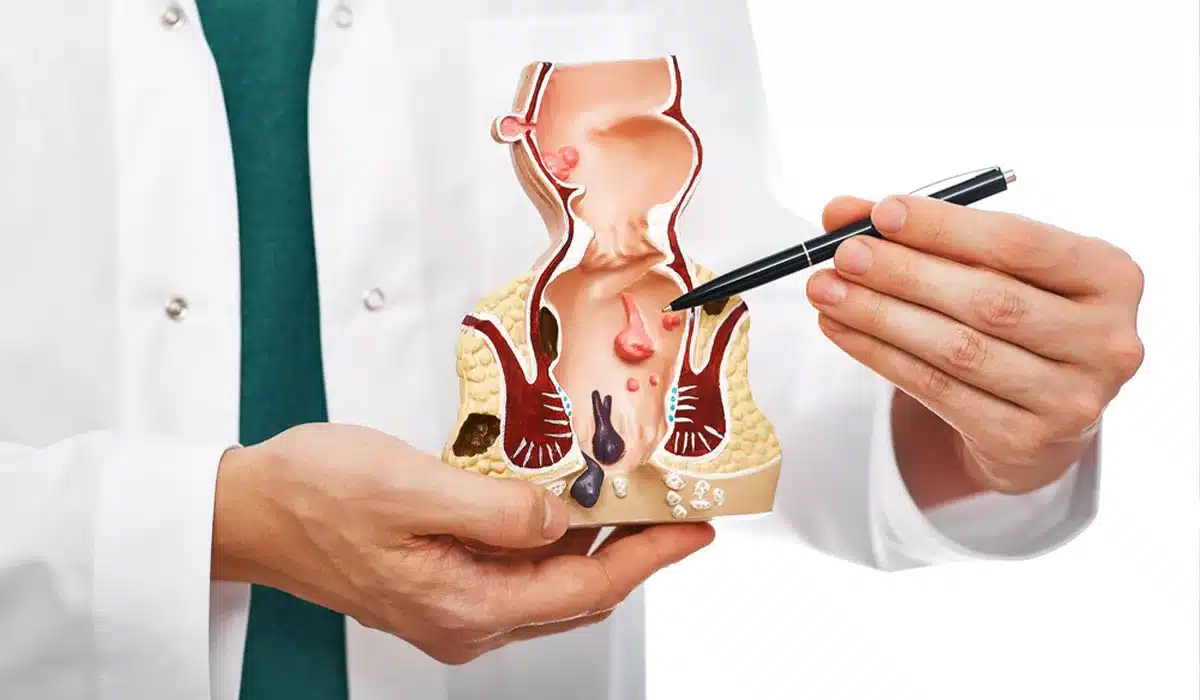 Геморроидэктомия по Миллигану-Моргану в Киеве Геморроидэктомия по Миллигану-Моргану в Киеве | в Adonis