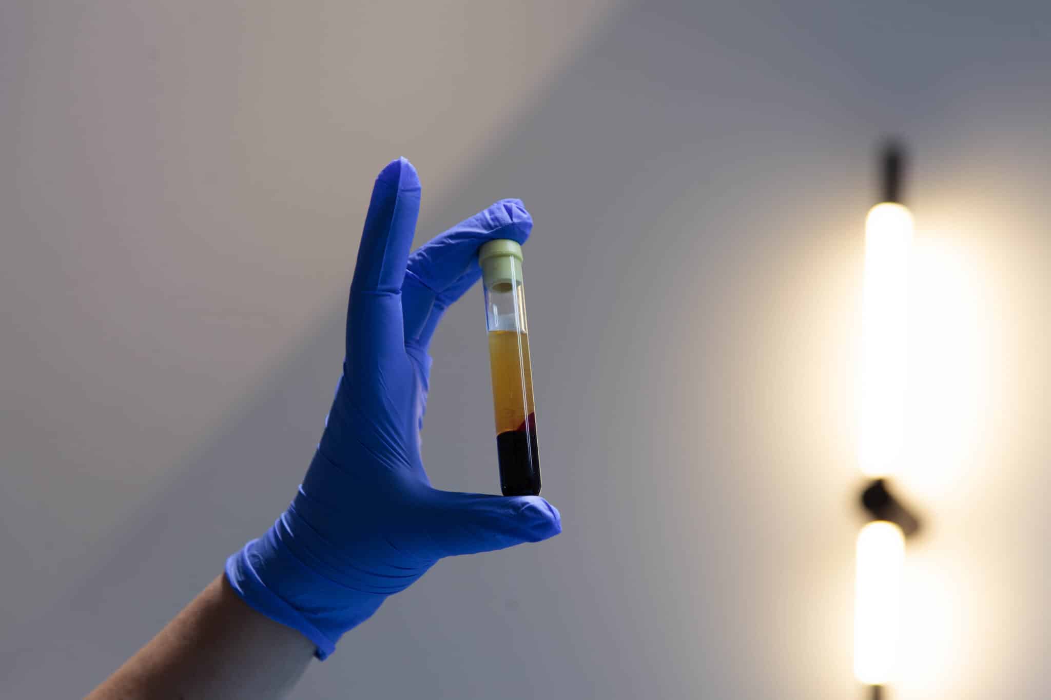 Що таке екзосоми для суглобів і як вони допомагають у лікуванні Що таке екзосоми для суглобів і як вони допомагають у лікуванні