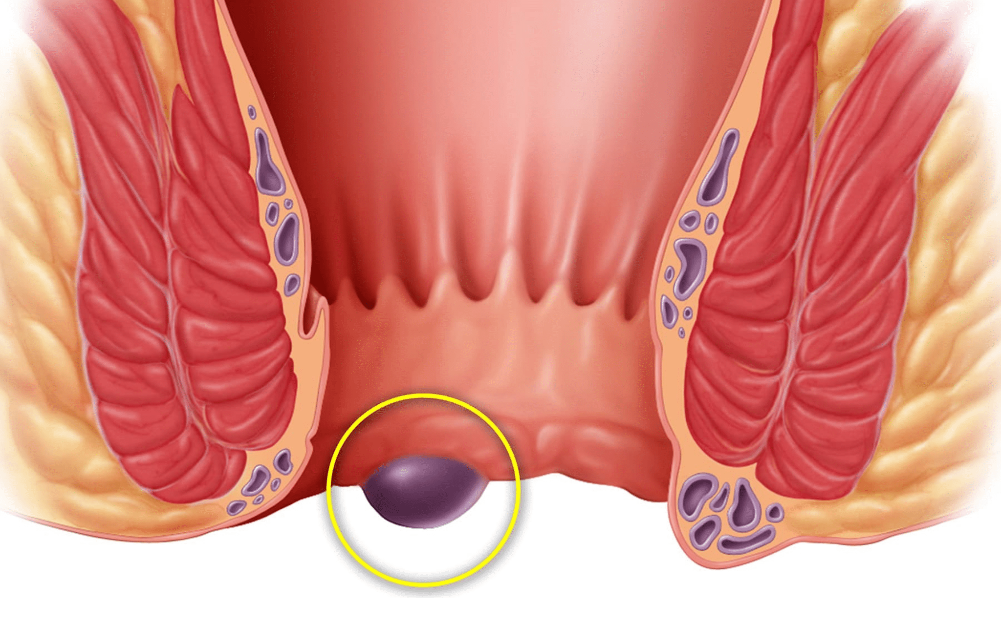 Лечение наружного геморроя в Киеве Лечение наружного геморроя в Киеве