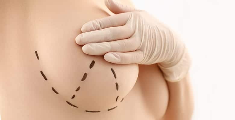 Коррекция сосков и ареолы I категории сложности Коррекция сосков и ареол в ADONIS