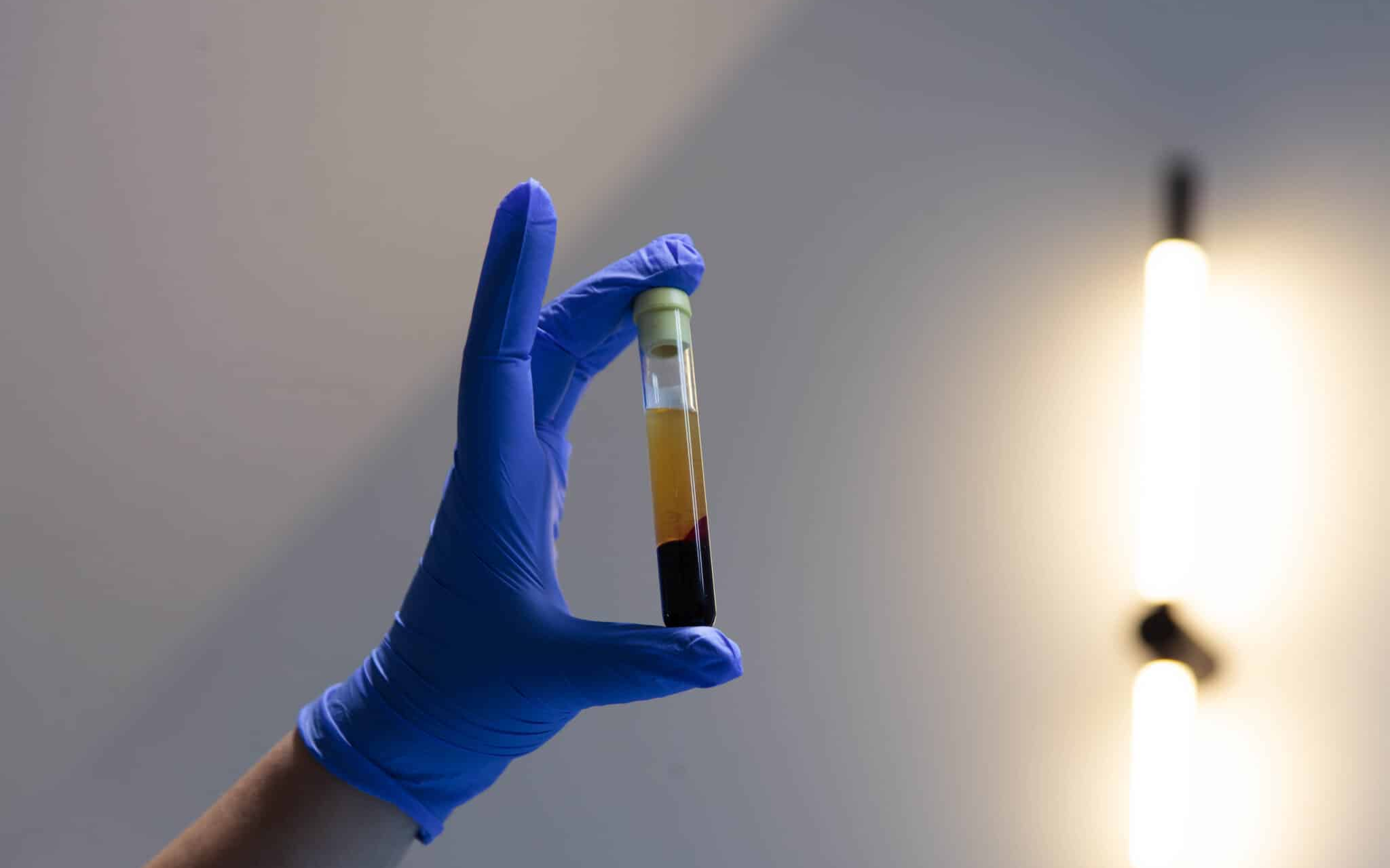 Лікування екзосомами суглобів Лікування екзосомами суглобів