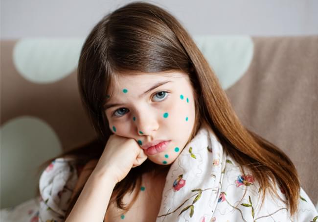 Як лікувати вітряну віспу у дітей та дорослих Вітрянка у дітей та дорослих.