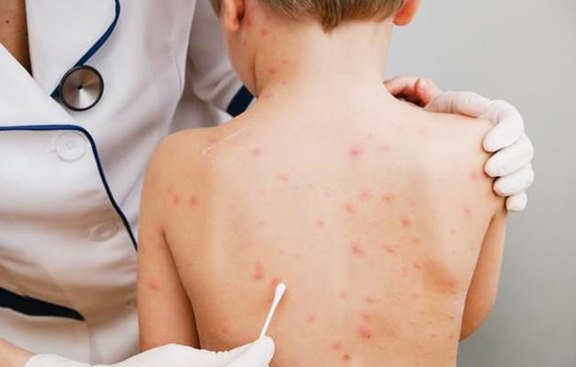 Как лечить ветрянку у детей и взрослых