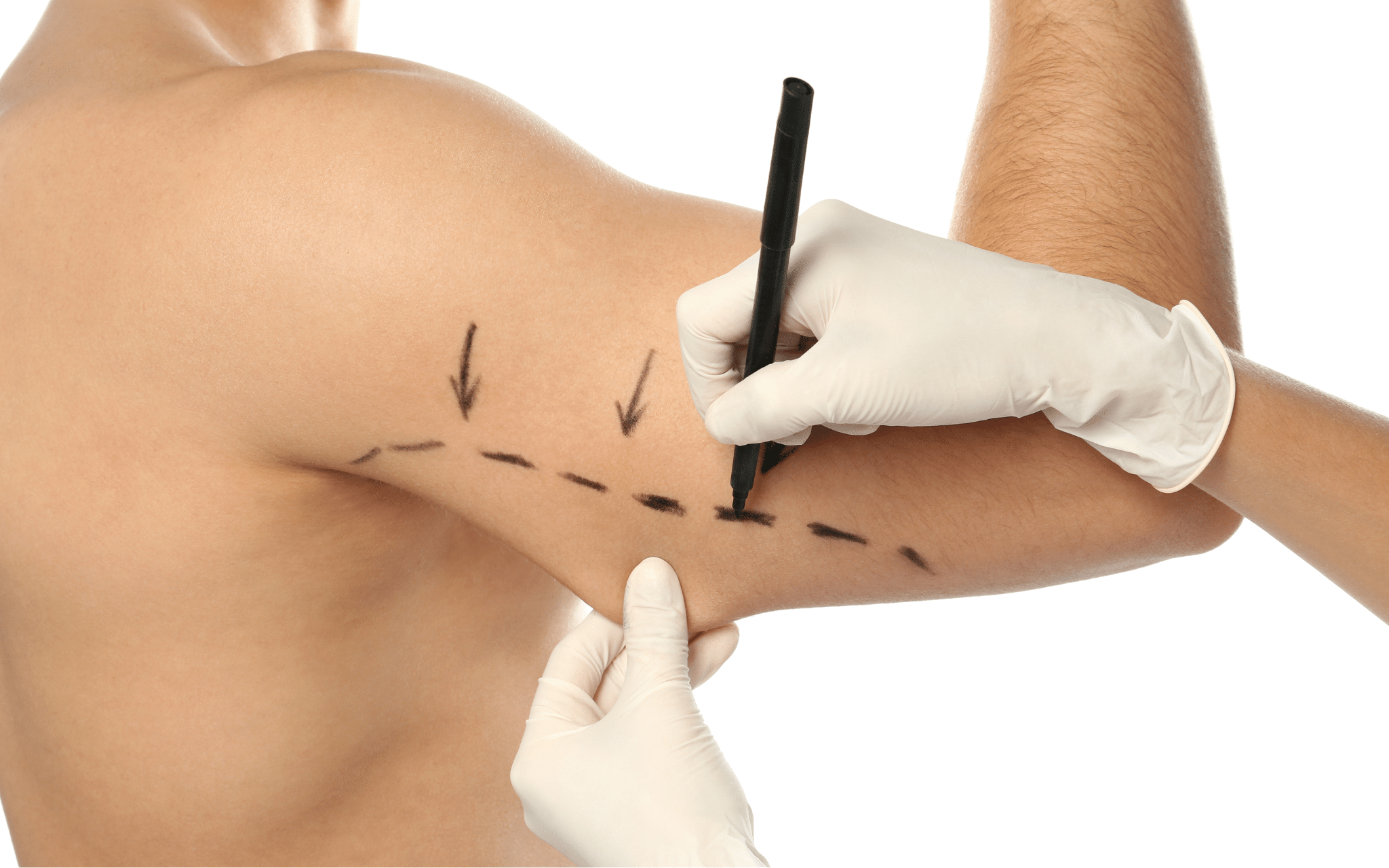 Брахіопластика (підтяжка шкіри рук) І категорії складності Брахіопластика (підтяжка шкіри рук) І категорії складності