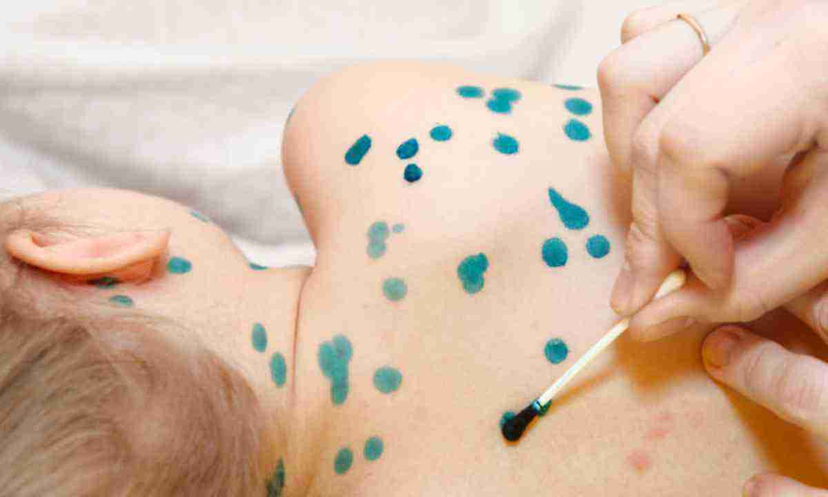 Як лікувати вітряну віспу у дітей та дорослих Як лікувати вітряну віспу у дітей та дорослих