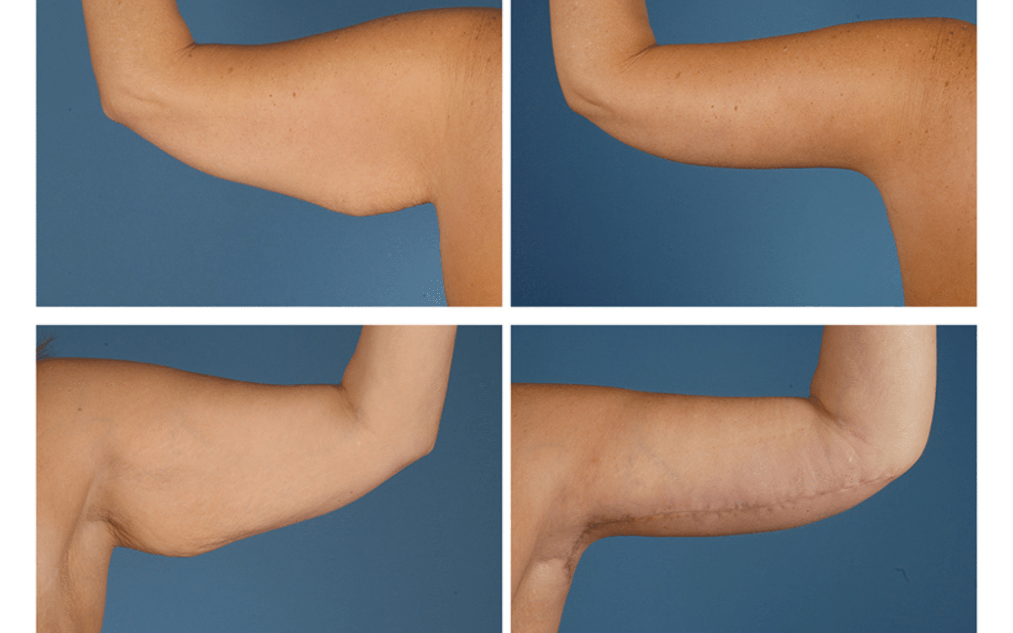 Брахіопластика (підтяжка шкіри рук) І категорії складності Брахіопластика (підтяжка шкіри рук) І категорії складності