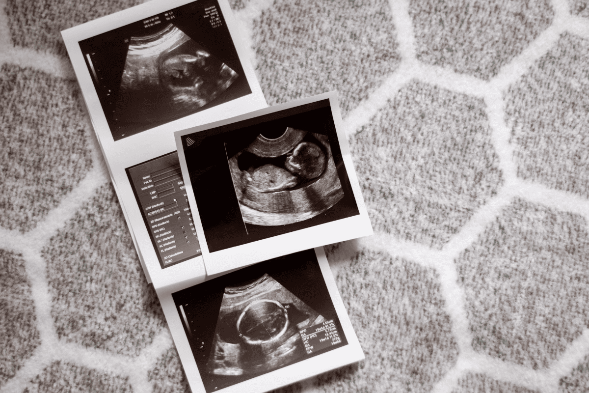 Скрининг 2 триместра беременности в Киеве Скрининг 2 триместра беременности в Киеве