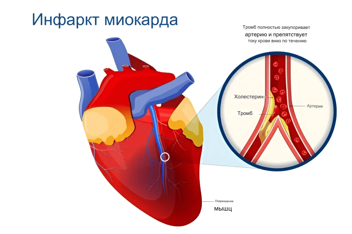 Лечение инфаркта миокарда в Киеве Лечение инфаркта миокарда в Киеве