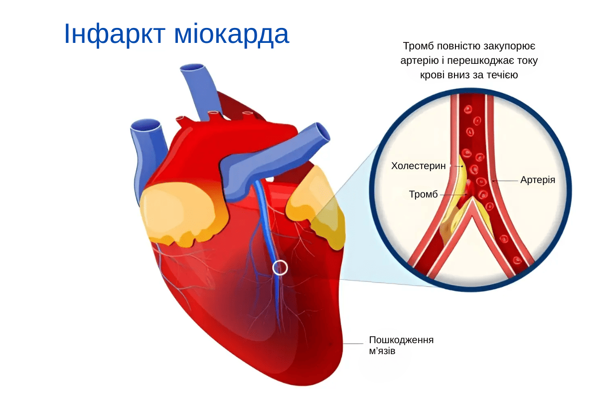 Лікування інфаркту міокарда у Києві Лікування інфаркту міокарда у Києві