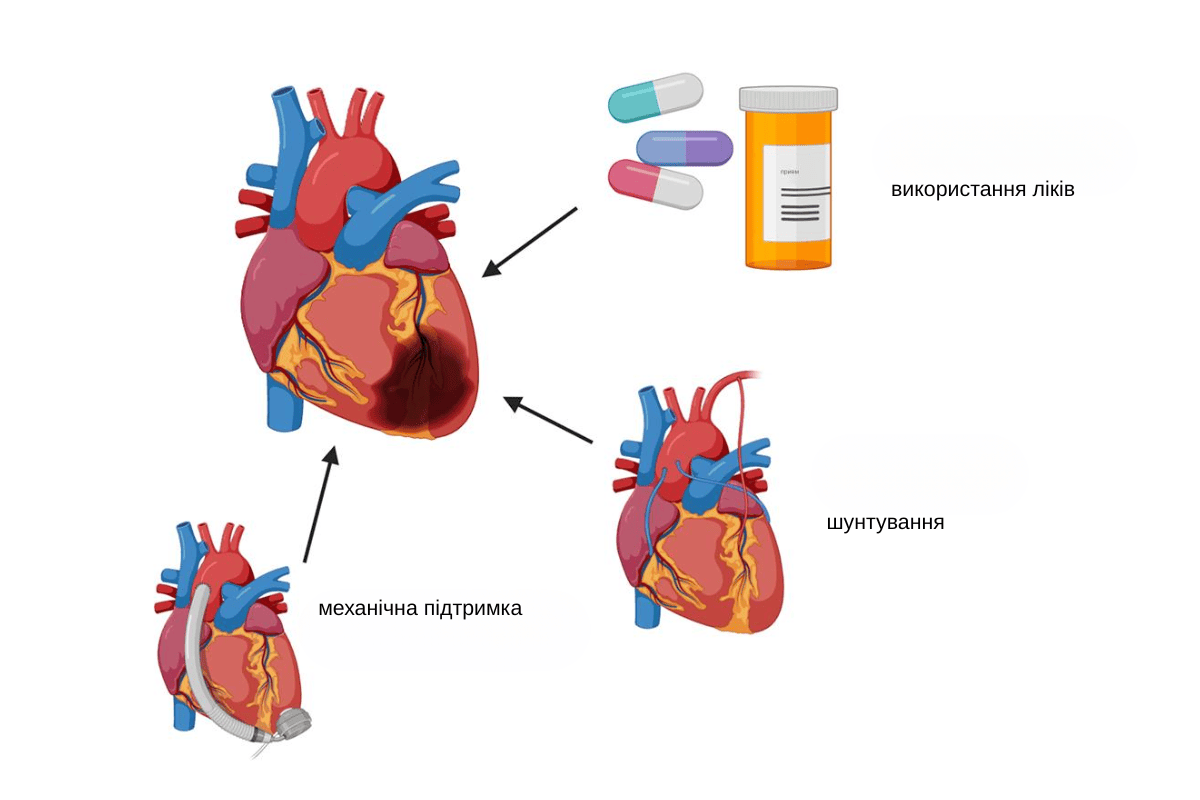 Лікування інфаркту міокарда у Києві Лікування інфаркту міокарда у Києві