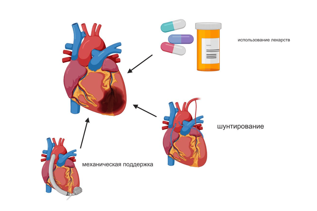 Лечение инфаркта миокарда в Киеве Лечение инфаркта миокарда в Киеве