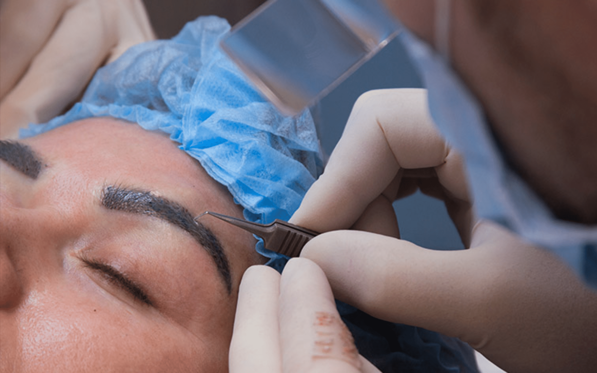 Пересадка бровей и бороды в Киеве Пересадка бровей и бороды в Киеве