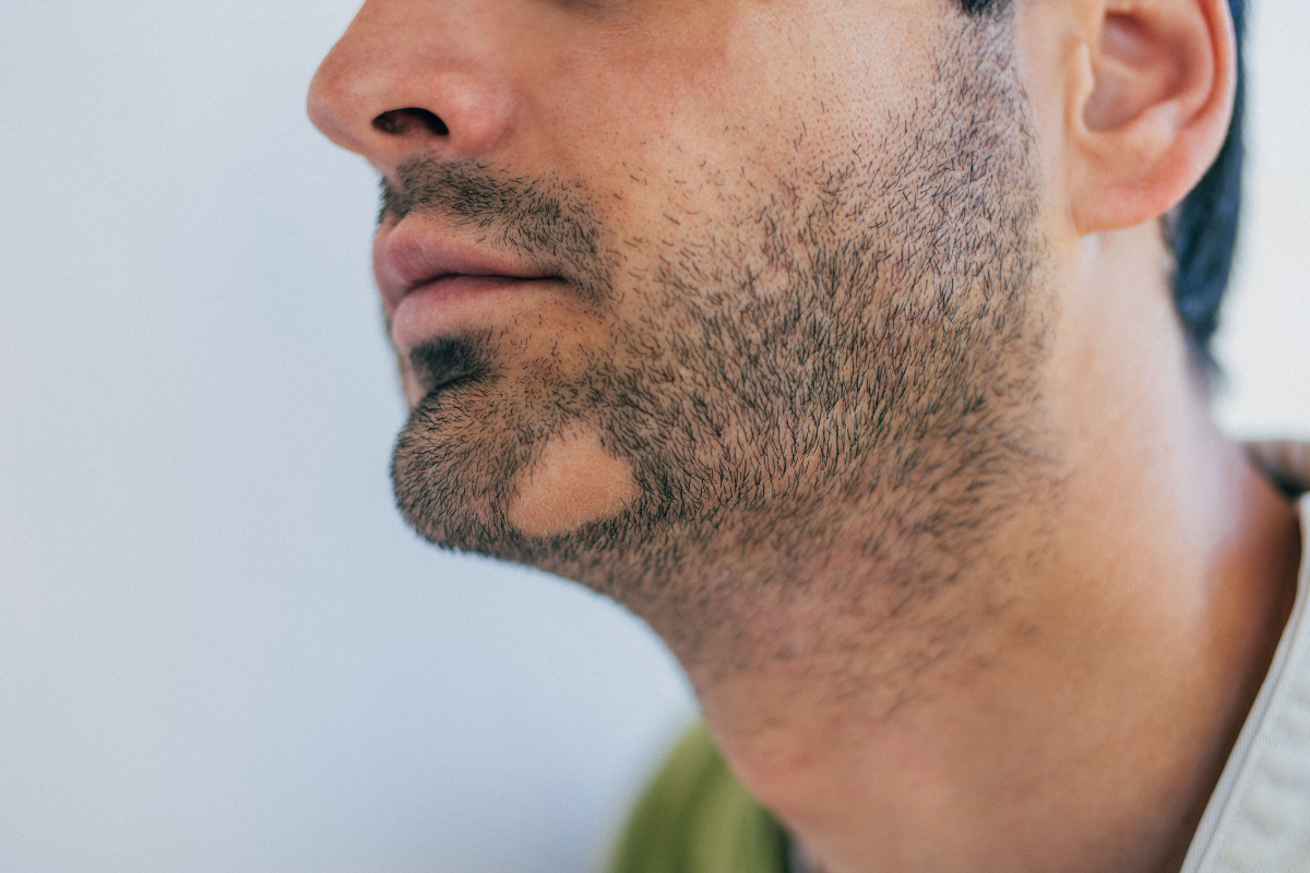 Пересадка бровей и бороды в Киеве Пересадка бровей и бороды в Киеве