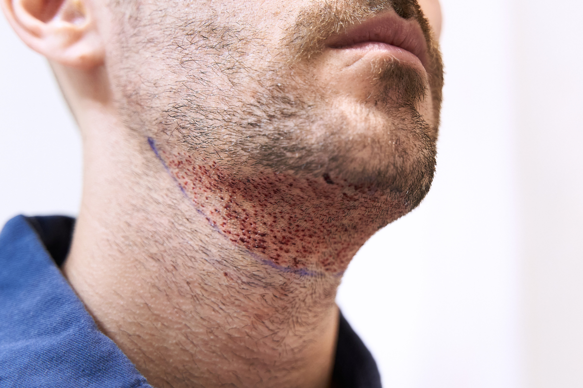 Пересадка бровей и бороды в Киеве Пересадка бровей и бороды в Киеве