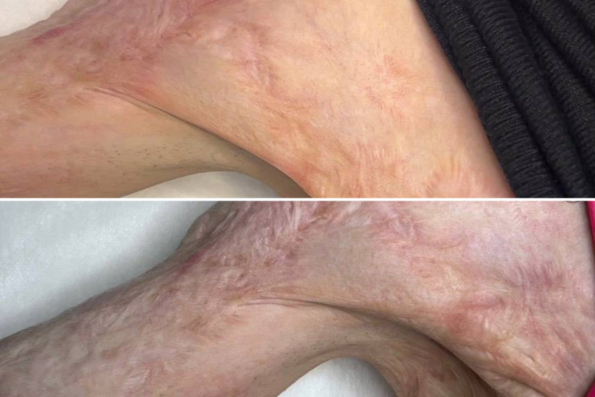 Экзосомы для устранения рубцов Экзосомы для устранения рубцов