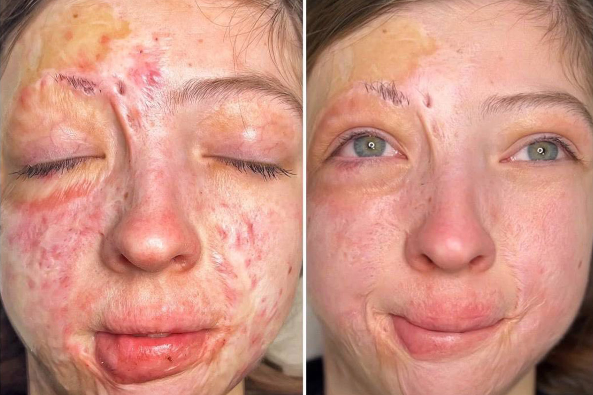 Экзосомы для устранения рубцов Экзосомы для устранения рубцов