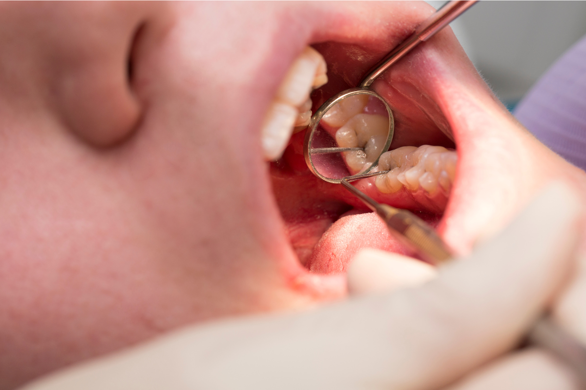 Лечение кариеса Лечение кариеса