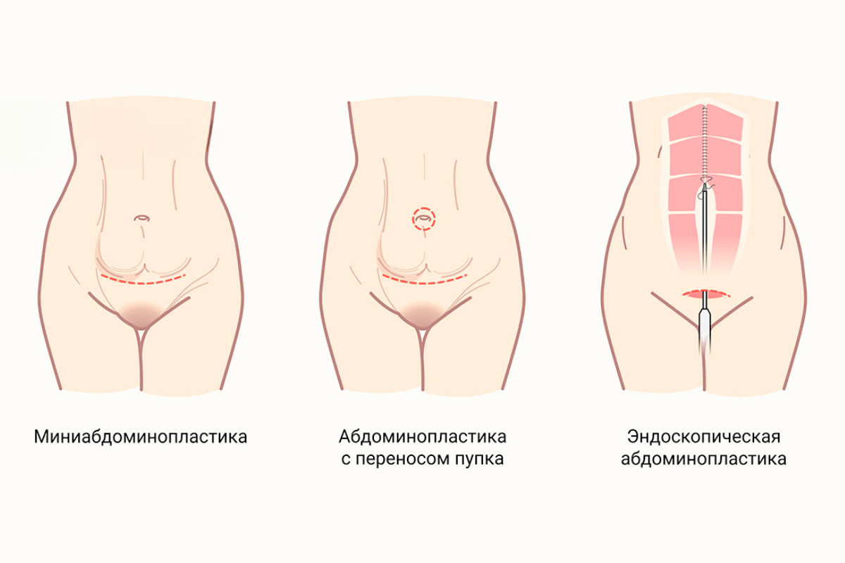 Миниабдоминопластика (пластика живота) в Киеве Миниабдоминопластика (пластика живота) в Киеве