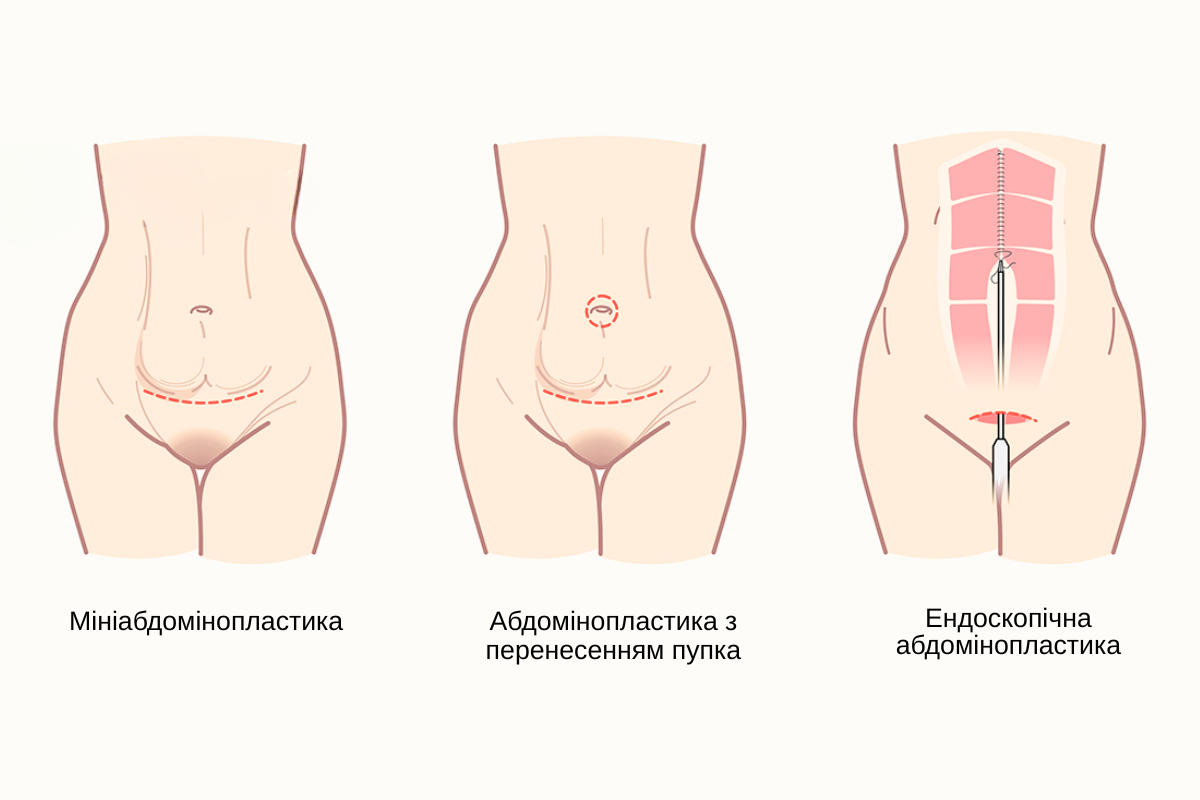 Мініабдомінопластика (пластика живота) в Києві Мініабдомінопластика (пластика живота) в Києві
