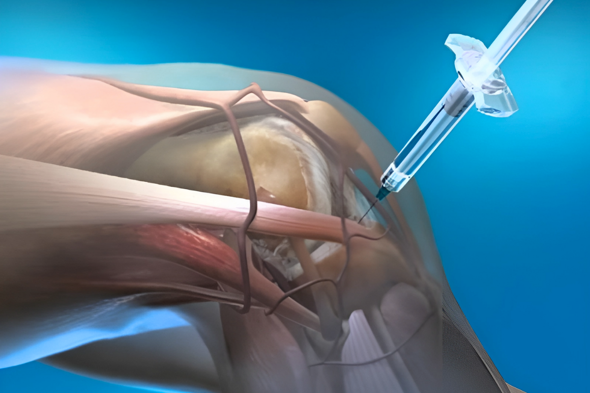 Екзосоми у травматології Екзосоми у травматології