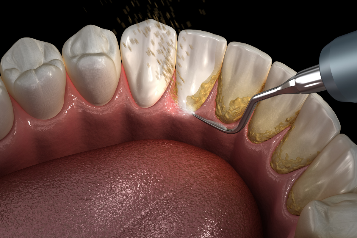 Профессиональная гигиена полости рта Профессиональная гигиена полости рта