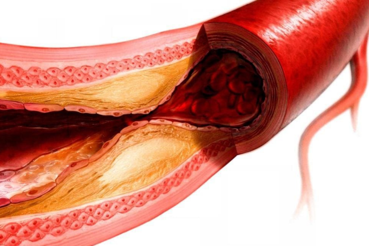 Що таке атеросклероз: причини, симптоми та методи лікування Що таке атеросклероз: причини, симптоми та методи лікування