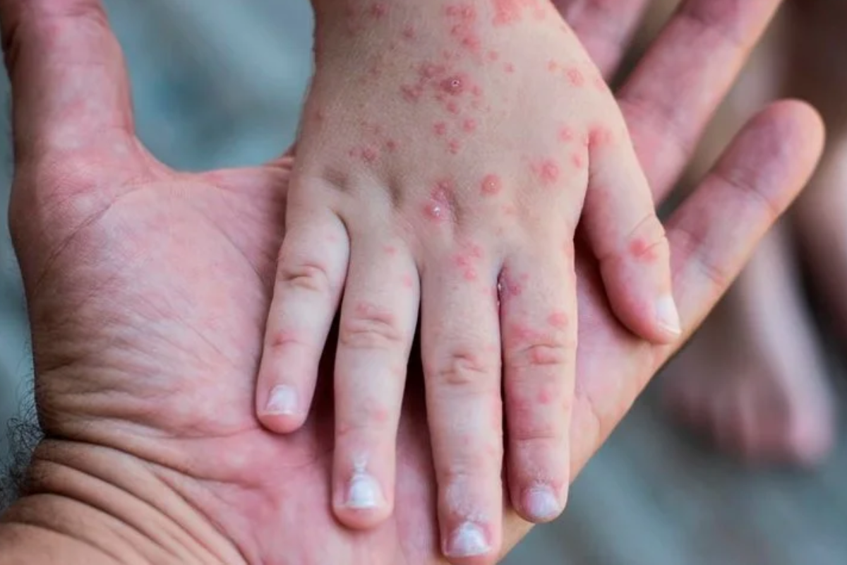 Вакцинация Бексеро от менингококковой инфекции в Киеве Вакцинация Бексеро от менингококковой инфекции в Киеве