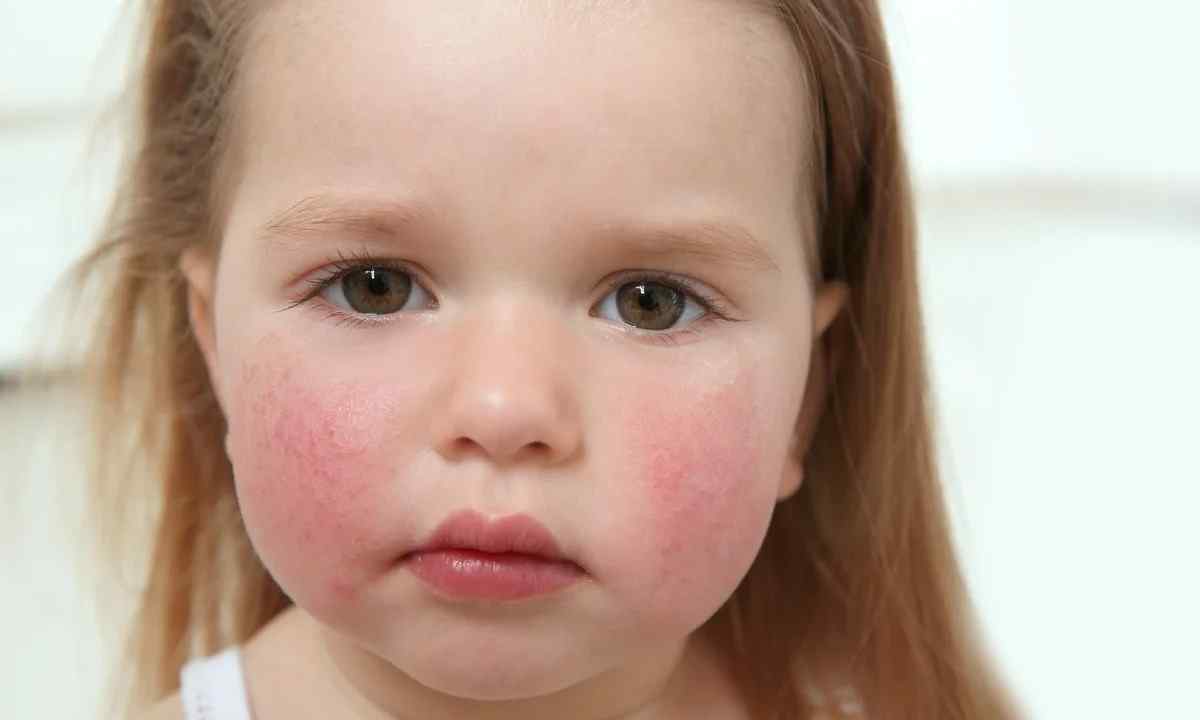 6554837018dbc_chim_nebezpechna_1 Скарлатина: симптомы, лечение в