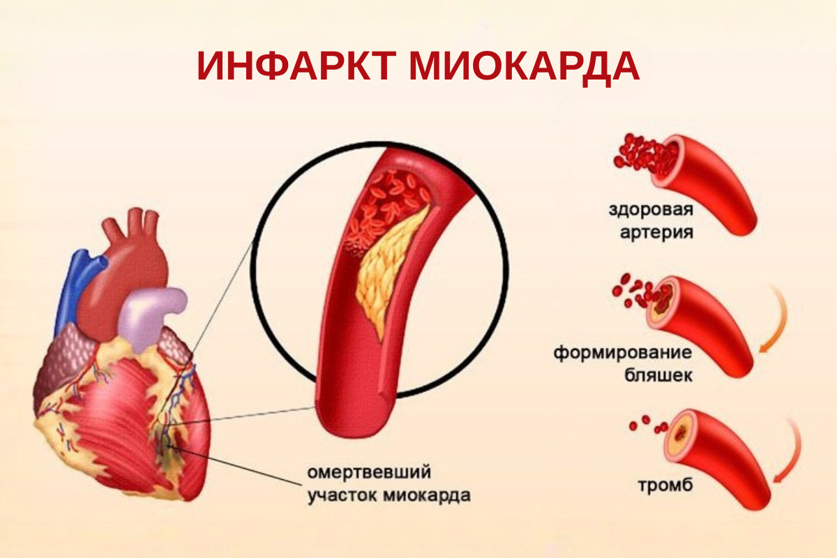 Как распознать инфаркт: симптомы, признаки, первая помощь Как распознать инфаркт: симптомы, признаки, первая помощь