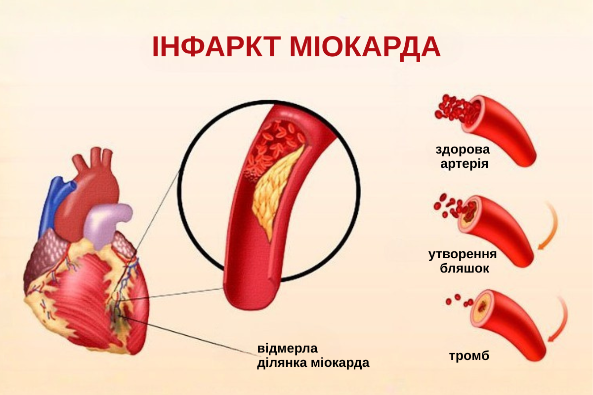 Як розпізнати інфаркт: симптоми, ознаки, перша допомога