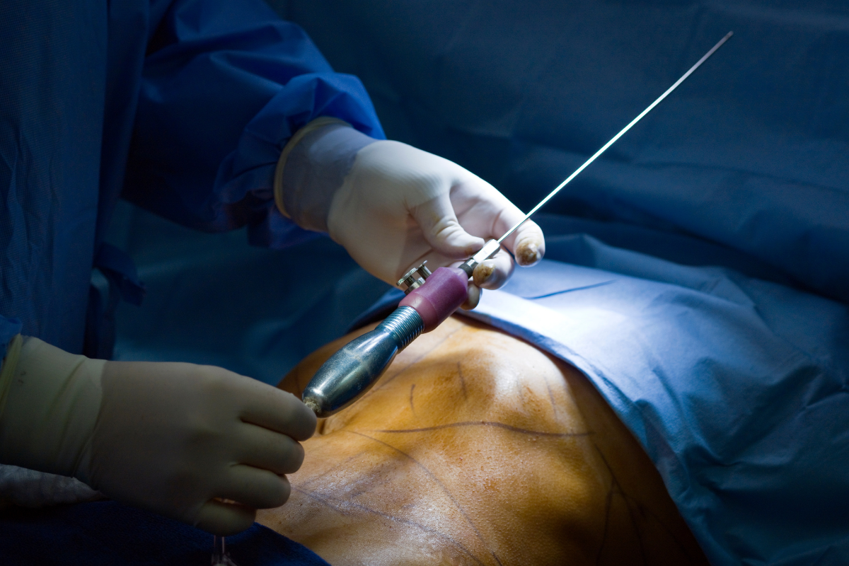 Тумесцентна ліпосакція у Києві Тумесцентна ліпосакція у Києві