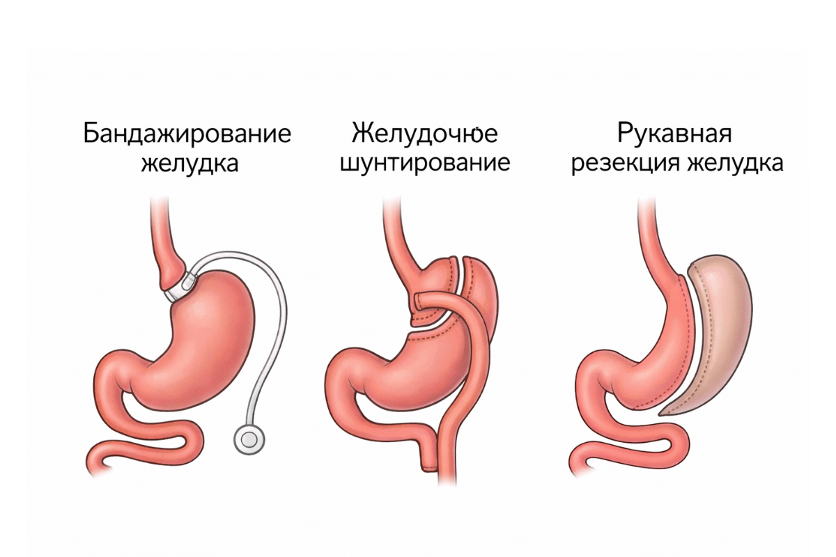 Бариатрическая операция в ADONIS: история пациента и медицинский подход Бариатрическая операция в ADONIS: история пациента и медицинский подход