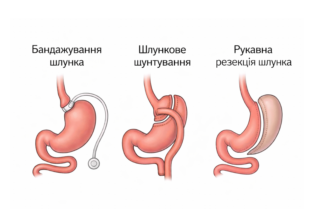 Баріатрична операція в ADONIS: історія пацієнта та медичний підхід Баріатрична операція в ADONIS: історія пацієнта та медичний підхід