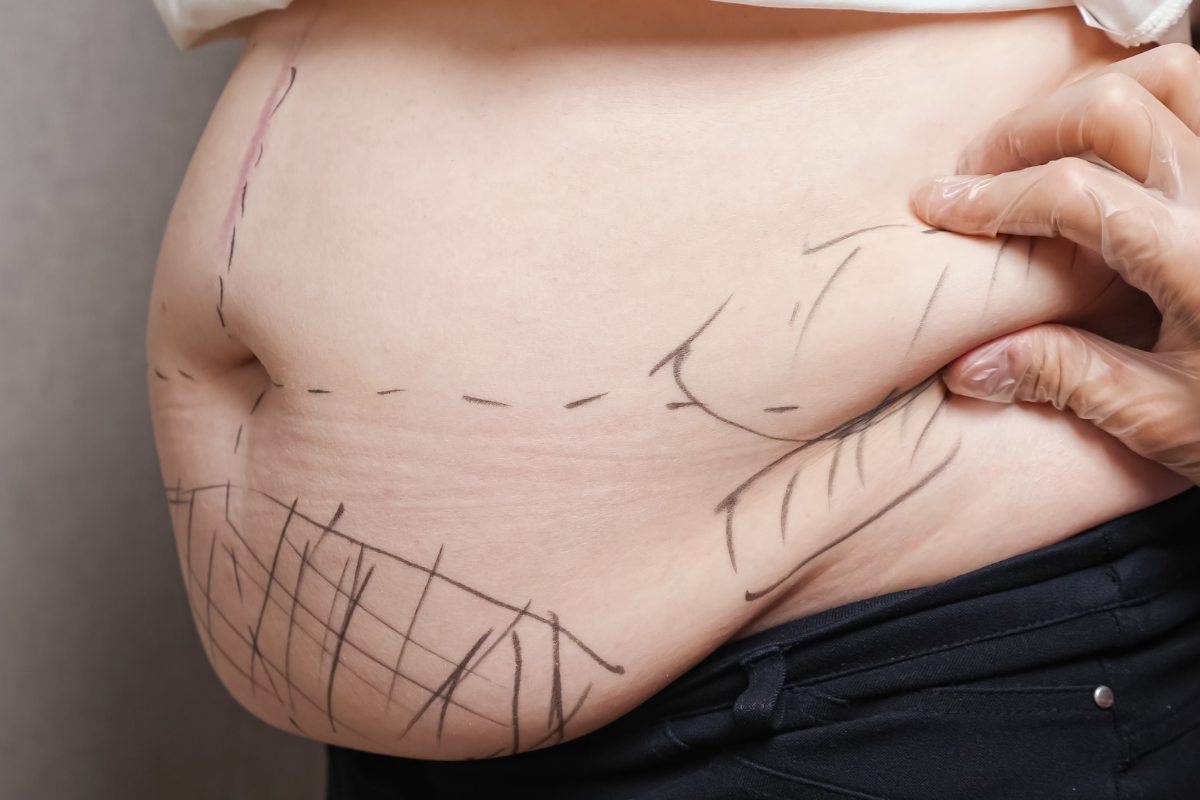 Тумесцентна ліпосакція у Києві Тумесцентна ліпосакція у Києві