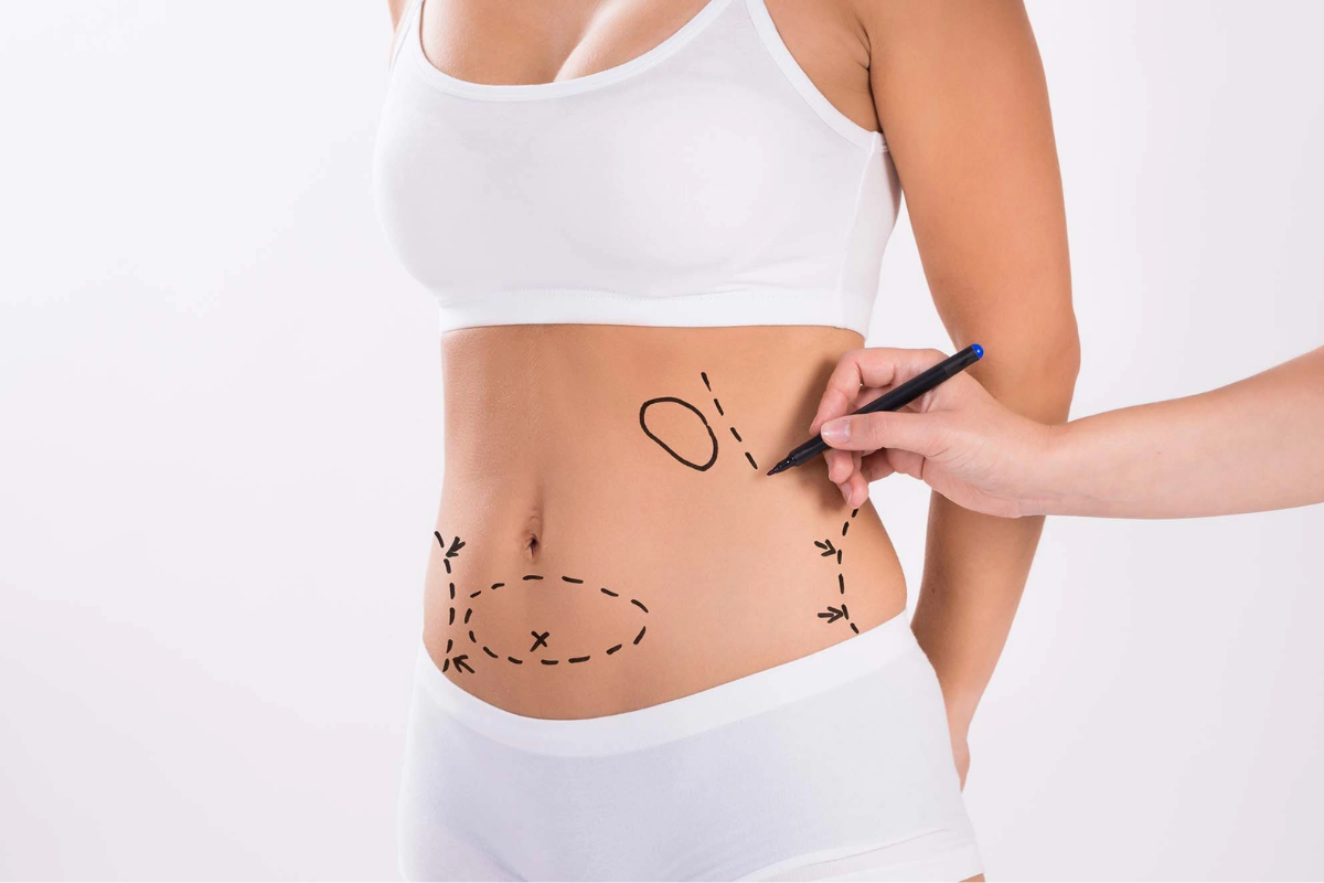 ліпосакція