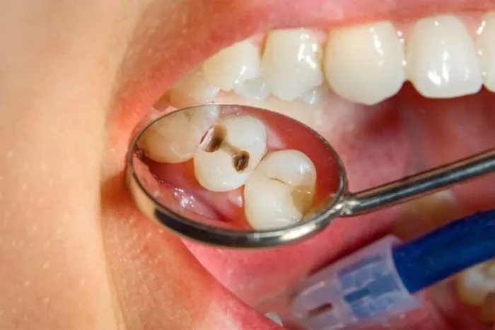 Лікування карієсу молочних зубів у дітей Особенности лечения кариеса молочных и постоянных зубов